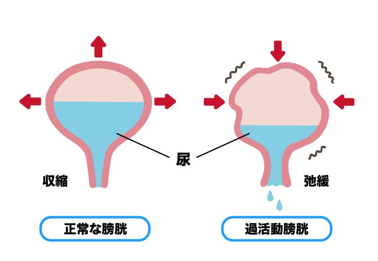 過活動膀胱｜横手市